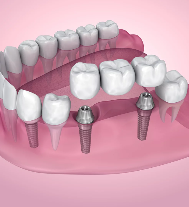 Dental Bridges Treatment in Indore