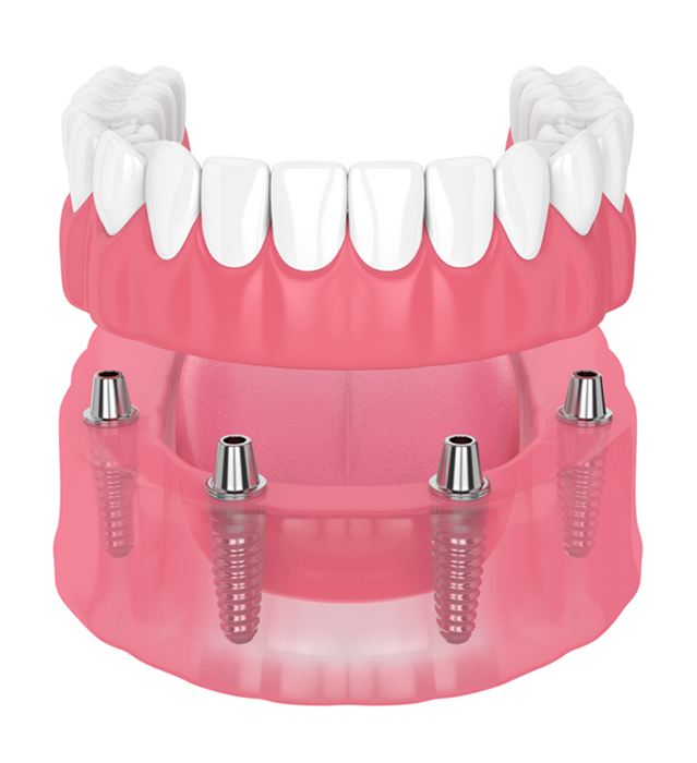 Fixed Dentures on Implants in Indore