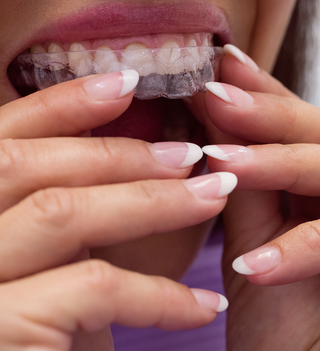 Sports Mouthguards for Children in Indore