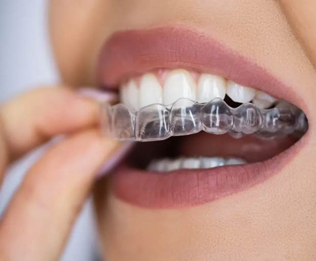 Clear Aligners in Indore