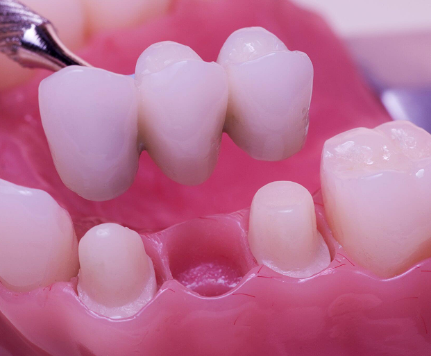 Dental Bridges Treatment in Indore