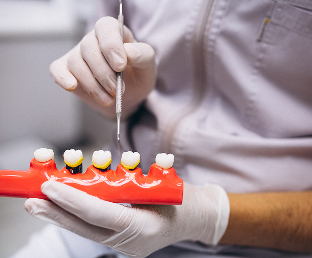 Best Dental Crowns Treatment in Indore
