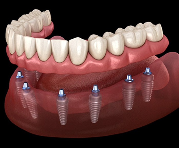 Fixed Dentures on Implants in Indore