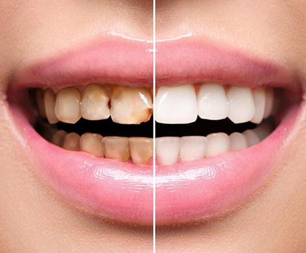 Dental Laminates in Indore
