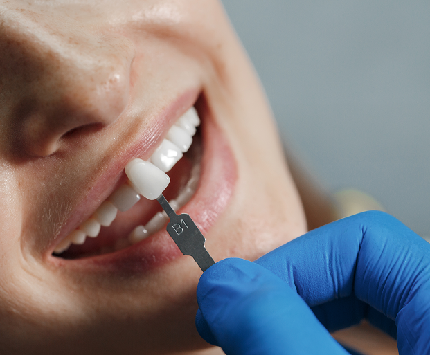 Dental Veneers Treatment in Indore